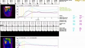 【泉一有普】核醫(yī)學科檢查大揭秘：腎動態(tài)顯像與全身骨顯像