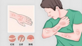 【泉一有普】銀屑病高頻16問，打破疾病迷霧，重尋生活曙光