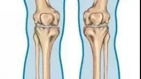 【泉一技術(shù)】“ K型腿復(fù)原記 ”骨科團(tuán)隊助嚴(yán)重膝外翻患者實現(xiàn)正常行走夢