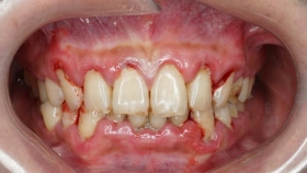 【泉一有普】別讓“上火”背鍋！牙齦出血背后的牙周炎真相