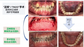 重塑微笑的「骨」動力——揭秘PAOO加速正畸技術(shù)