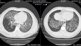 【泉一技術(shù)】肺里洗出大量“牛奶”？多學科團隊成功開展一例全肺灌洗術(shù)！