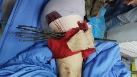 【泉一技術(shù)】多根鋼筋穿過大腿，男子命懸一線
