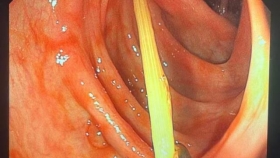 【泉一技術(shù)】不明原因腹痛5日，真相竟是--“生吞牙簽”？