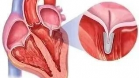 【泉一技術(shù)】突破！我院心血管外科成功完成首例經(jīng)導(dǎo)管二尖瓣鉗夾術(shù)，82歲高齡重癥患者重獲“心”生